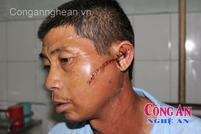 Anh Phan Văn Luật bị chém vô cớ, đang điều trị tại bệnh viện