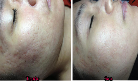 HÌNH ẢNH THỰC TẾ KHÁCH HÀNG SỬ DỤNG COLLAGEN TRỊ SEO THÂM MỤN HÌNH ẢNH THỰC TẾ KHÁCH HÀNG SỬ DỤNG COLLAGEN TRỊ SEO THÂM MỤN