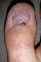 Big Toenail Removal - Right Foot - 18 Weeks & 4 Days