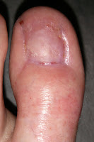 Big Toenail Removal - Left Foot - 16 Weeks & 4 Days