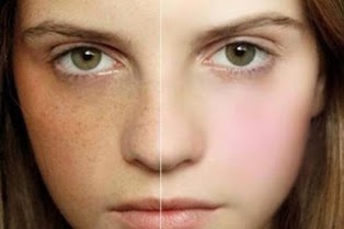 Sử dụng sữa ong chúa tươi: Trị tàn nhang, đồi mồi, nám da