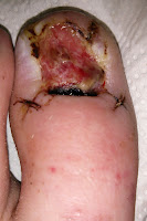 Big Toenail Removal - Left Foot - 2 Weeks & 1 Day