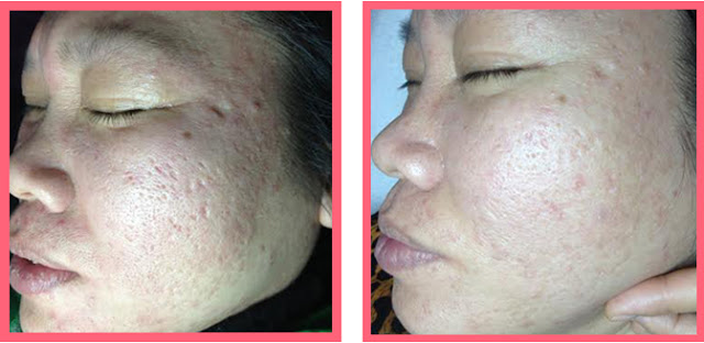Collagen trị thâm mụn loại nào tốt ? Collagen trị thâm mụn loại nào tốt ?