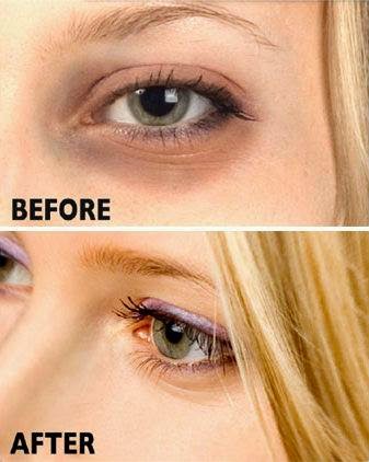 How to Get Rid of Dark Circles