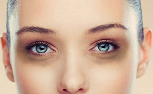Natural remedy for removing dark circles