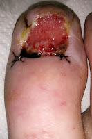Big Toenail Removal - Right Foot - 2 Weeks & 1 Day