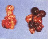 Hình 5: Nang trứng sung huyết, xuất huyết, hoại tử (bên phải)