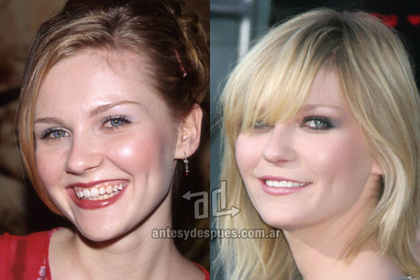 Kirsten Dunst y sus nuevos dientes, antes y despues