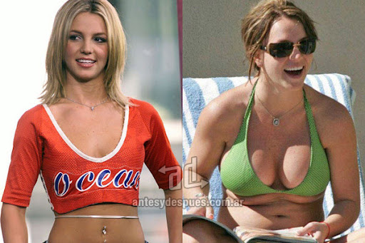 Britney Spears before and after breast augmentation