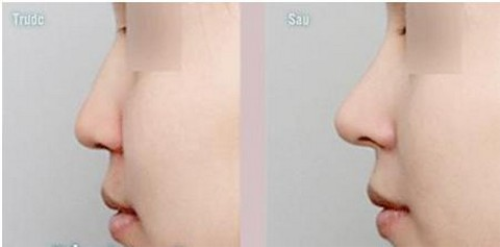 Nâng mũi không phẫu thuật tại Dr. Văn