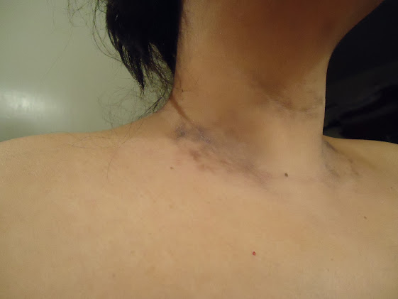 brown spots on neck #11