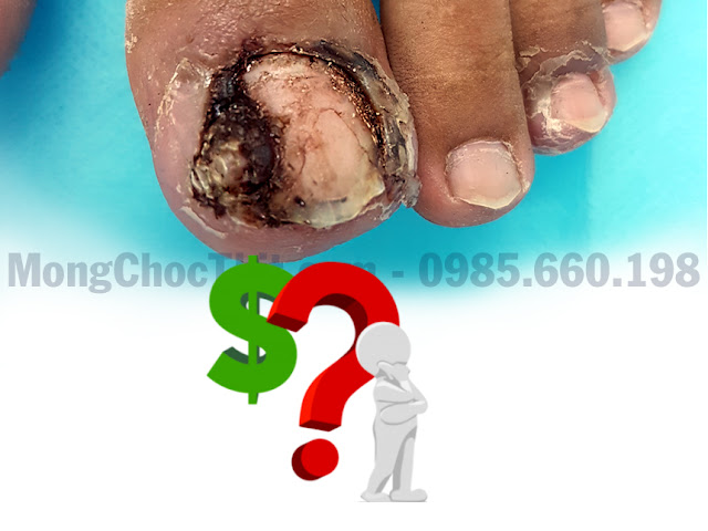 phí chữa bệnh móng chọc thịt chi phí tiểu phẫu móng chọc thịt