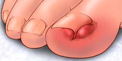 Móng chọc thịt dùng thuốc gì để điều trị?