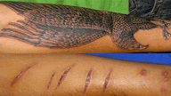 Tattoos Over Scars Meps