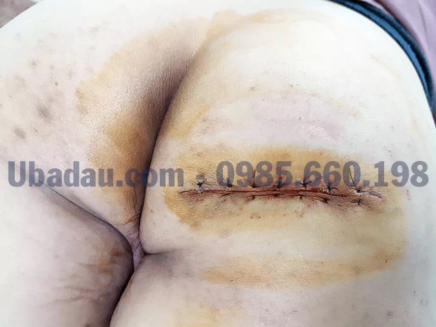 Sau khi cắt bỏ toàn bộ khối u Sau khi cat bo toan bo khoi u