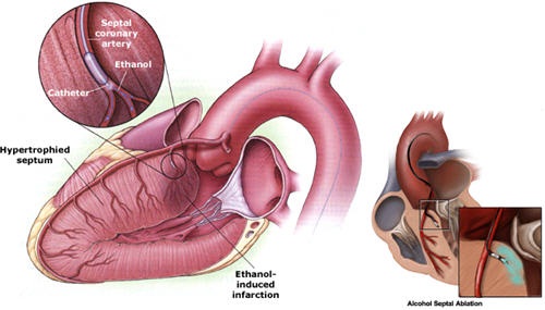 Bệnh cơ tim - Nguyên nhân dẫn đến suy tim