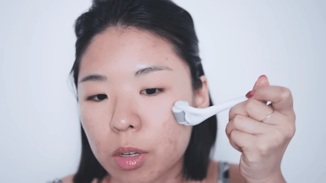 cách chữa trị rạn da
