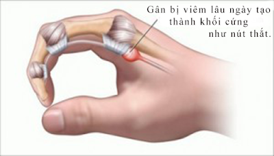 Minh hoạ tổn thương gân gấp trong bệnh ngón tay cò súng