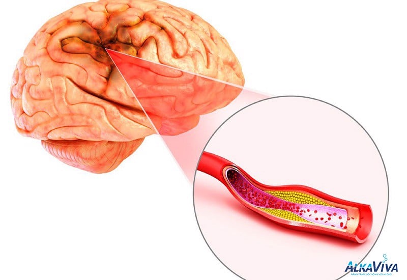 NƯỚC ĐIỆN GIẢI ION KIỀM CÓ GIÚP PHÒNG CHỐNG ĐỘT QUỴ KHÔNG?