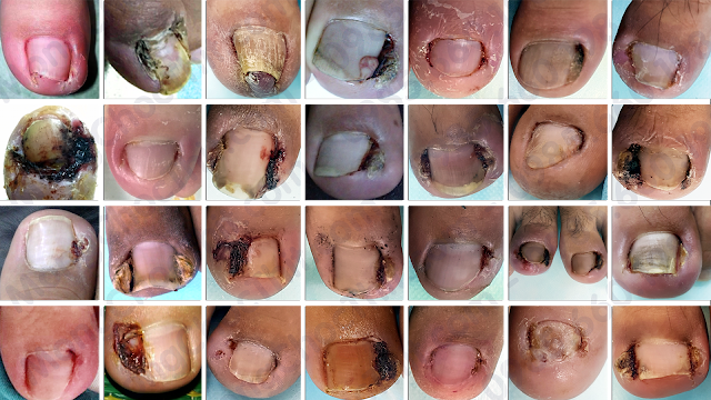 viêm khoé móng, sưng khoé móng khoé chân chảy mủ, sưng khoé chân