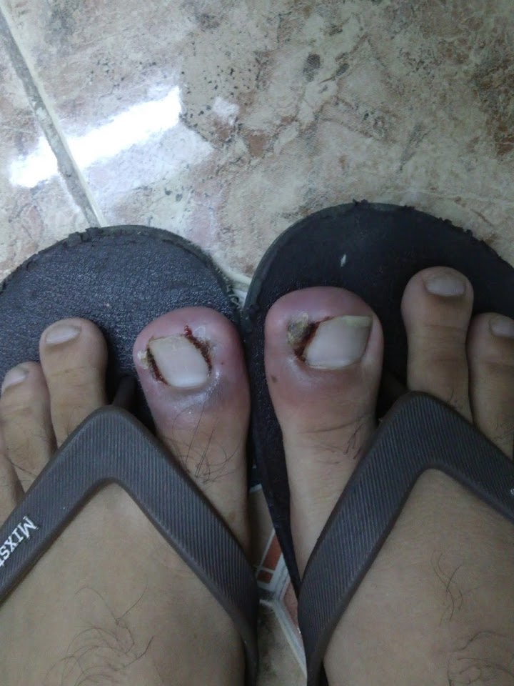 Truong hop bi thoi mong chan ngon cai 2 ben