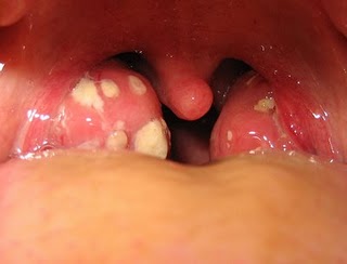 ubat tonsil