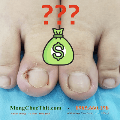 Chi phí tiểu phẫu điều trị móng chọc thịt là bao nhiêu