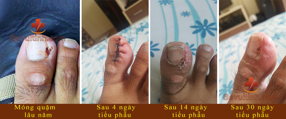 Mong choc thit hon 2 nam, tai di tai lai nhieu lan mac du da dieu tri nhieu noi