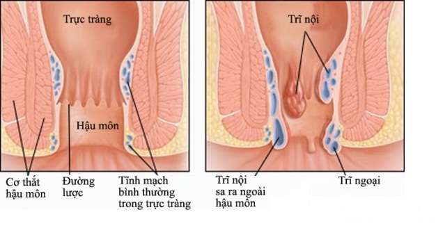 Bệnh trĩ nội hình thành bên trên đường lược nằm bên trong ống hậu môn