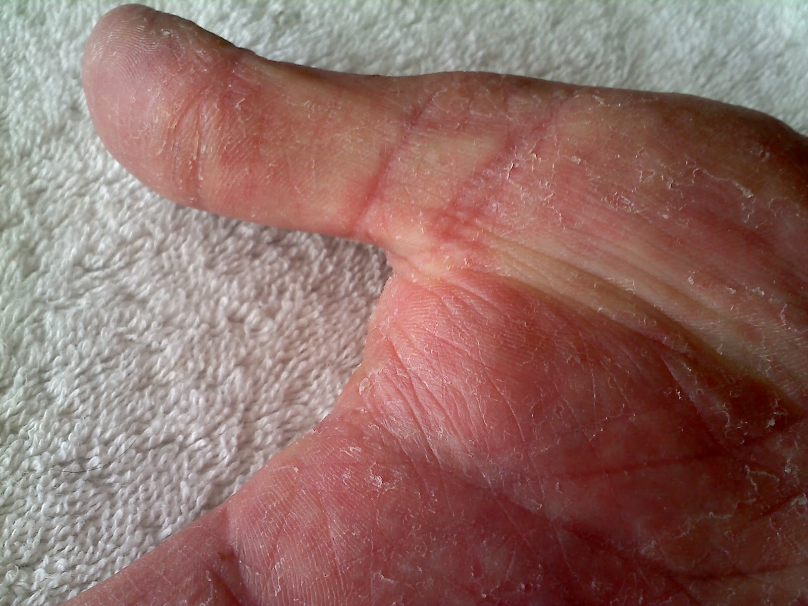 skin rashes on fingers