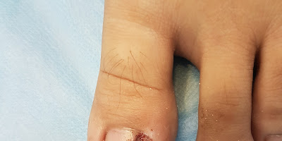MÓNG CHỌC THỊT (MÓNG QUẶM) VÀ CÁCH ĐIỀU TRỊ HIỆU QUẢ