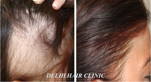 Delhi Hair Clinic, Delhi Nursing Home Near Fauji Chowk, Bibi Wala, Bathinda, Punjab 151001, India, Hair_Transplantation_Clinic, state PB