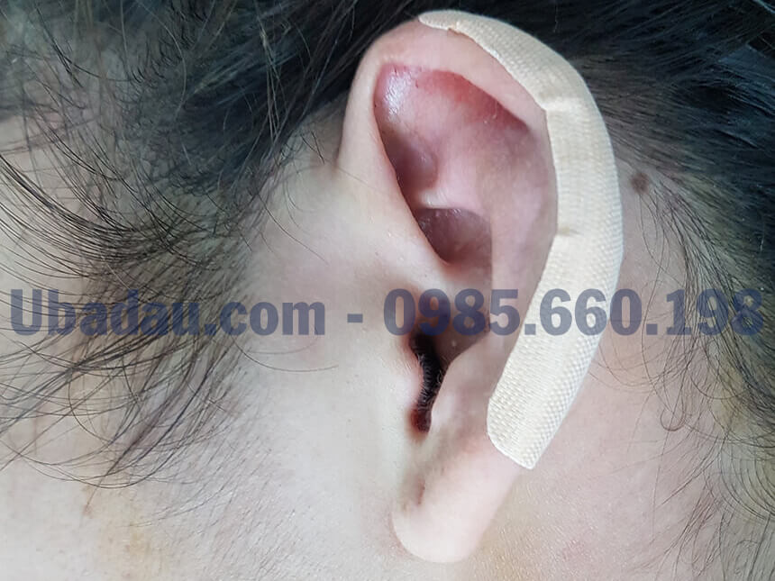 phẫu thuật u sụn vành tai