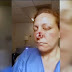 Man Bites Off Woman's Nose After She Broke Up With Him