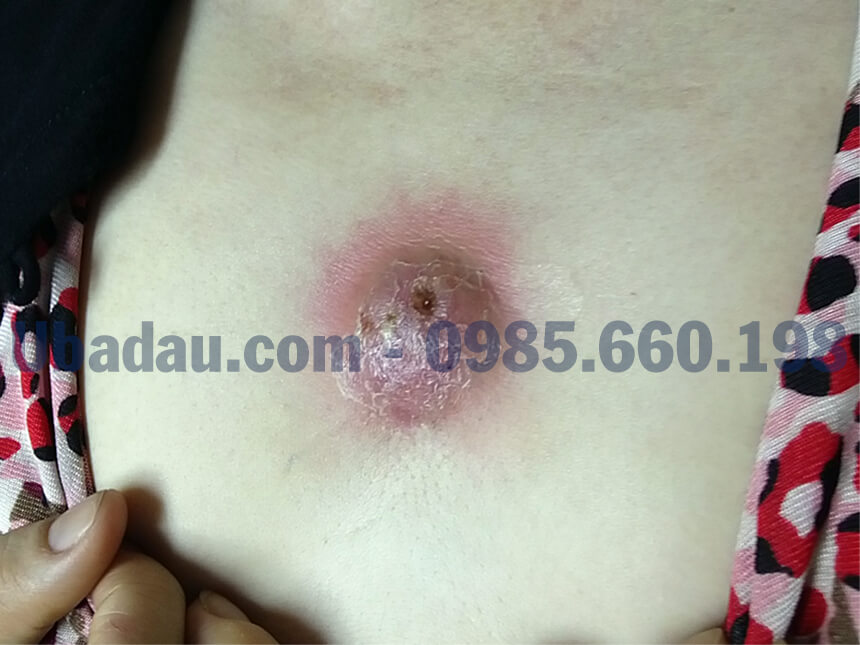 U bã đậu vùng ngực bội nhiễm U-ba-dau-vung-nguc-boi-nhiem