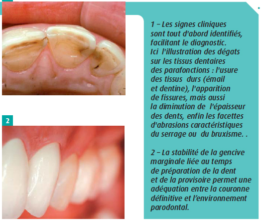 Les paramètres techniques et décisionnels de l’efficacité en prothèse fixée