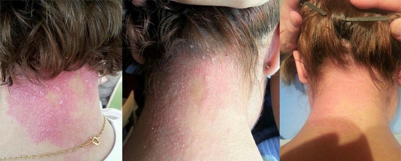 El tratamiento agudo atopicheskogo de la dermatitis