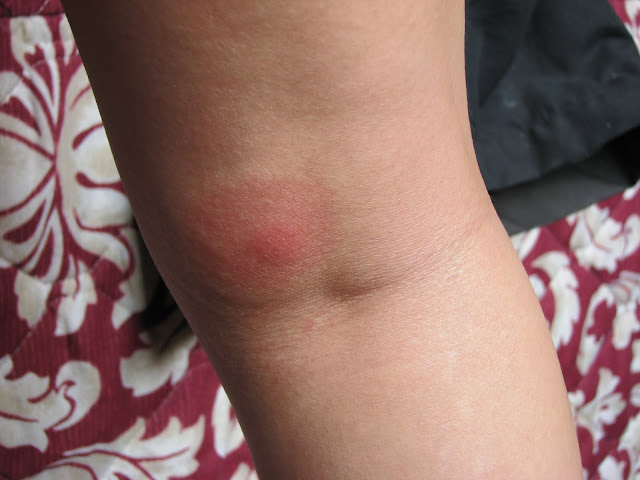 spider bite