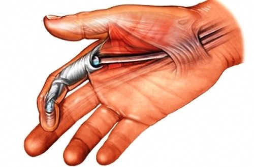 Minh hoạ ngón tay bị hội chứng ngón tay lò xo Minh hoạ ngón tay bị hội chứng ngón tay lò xo