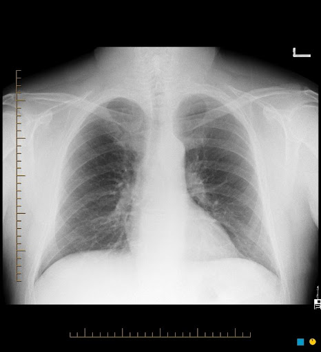 Normal+ct+scan+chest