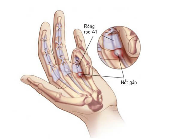 Hình ảnh minh hoạ vị trí gân bị viêm trong bệnh ngón tay lò xo