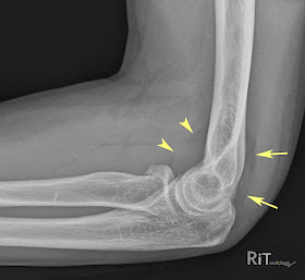 橈骨頭骨折(Radial Head Fracture)-lh4.googleusercontent.com