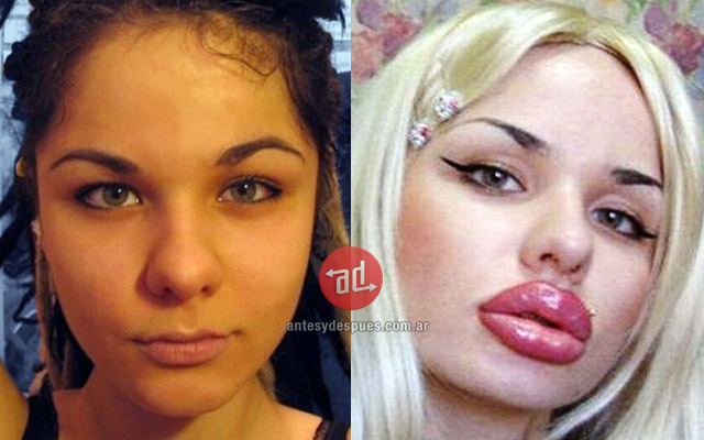 Lip augmentation of Kristina Rei