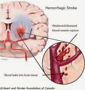 Obat Sakit Stroke Aman & Tanpa Efek Samping