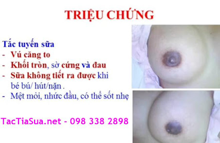 biểu hiện tắc tia sữa tac-tia-sua-bieu-hien-nhu-the-nao