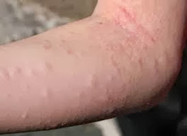 Solusi Sehat Pengobatan Alergi Pada Kulit