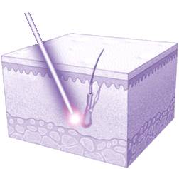 laser for hair removal laser for hair removal