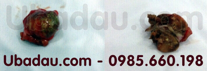 u bã đậu ở nách khi mổ ra u ba dau ở nách khi mổ ra
