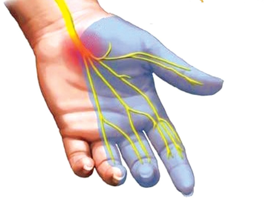 Minh hoạ dây thần kinh giữ bị chèn ép gây tê các ngón 1, 2, 3 và nửa ngón 4 (ngón nhẫn) Minh hoạ dây thần kinh giữ bị chèn ép gây tê các ngón 1, 2, 3 và nửa ngón 4 (ngón nhẫn)