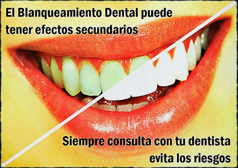 blanqueamiento-dental